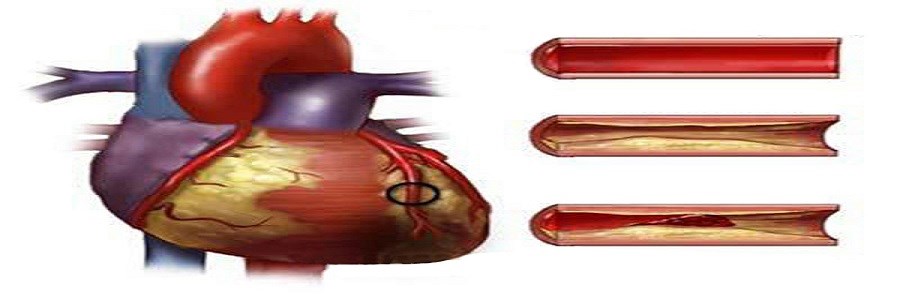 اسیدهای چرب غیر اشباع موجب کاهش بروز بیماری کرونر قلبی می شوند