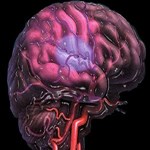 ویتامین C و پیشگیری از  سکته مغزی هموراژیک
