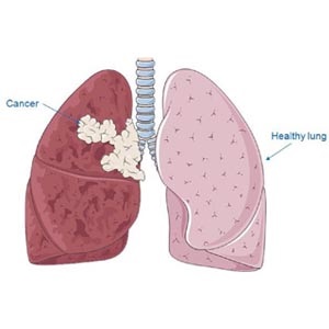 سیگار چگونه خطر سرطان ریه را افزایش می‌دهد؟