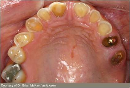 اختلالات غذا خوردن سبب فرسایش مینای دندان می شوند