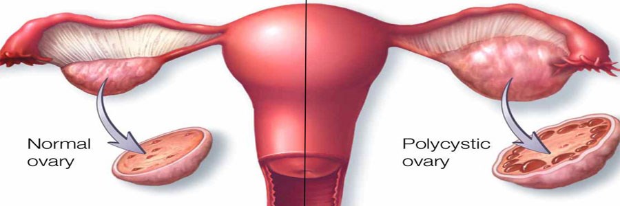 ارتباط میکروب های معده ای با ابتلا به سندرم تخمدان پلی کیستیک
