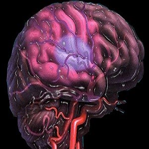 ویتامین C و پیشگیری از  سکته مغزی هموراژیک
