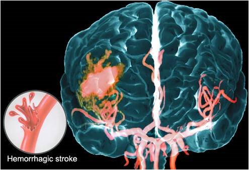 سکته هموراژیک